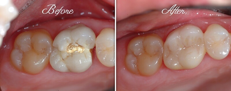 Crown Restoration Before and After