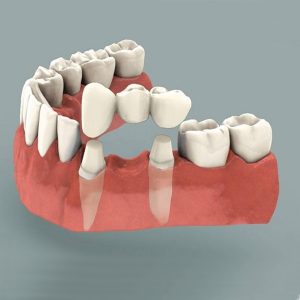 Dental Bridge