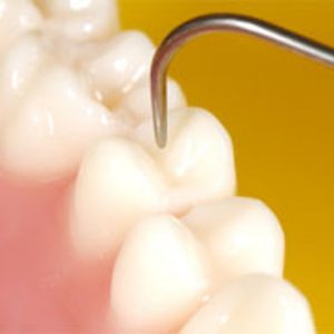 Dental Fillings